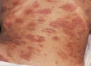 Kasus HIV/AIDS di Kendari Tembus 2.023 Orang per Mei 2025