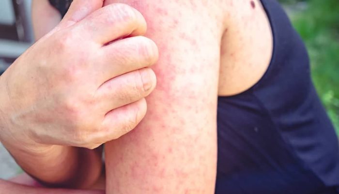 Darurat HIV Sultra: Kasus Tembus 2.900, Wagub Hugua Soroti 1.000 ODHA Tak Berobat Rutin