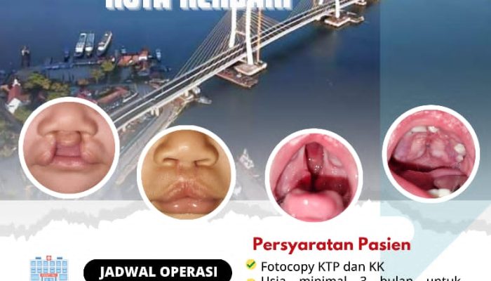 RSU Aliyah 3 Kendari dan Mitra Buka Pendaftaran Operasi Bibir Sumbing Gratis